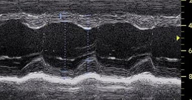 M-mode echocardiogram tracing of heart motion