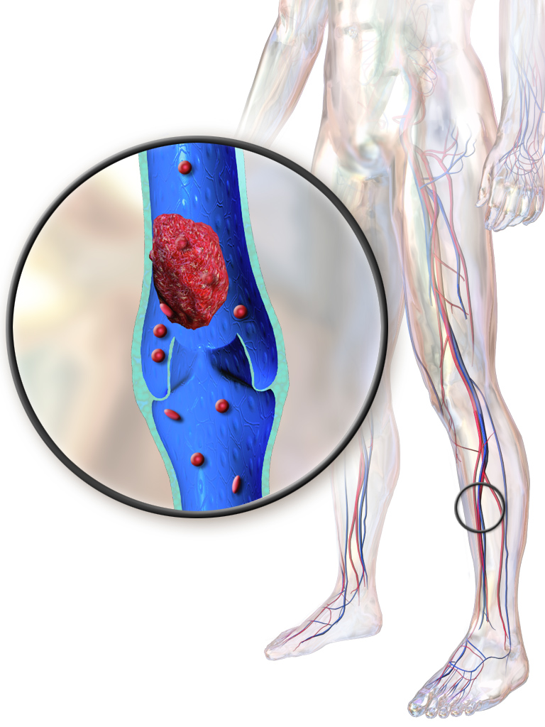 Medical illustration showing deep vein thrombosis in the leg