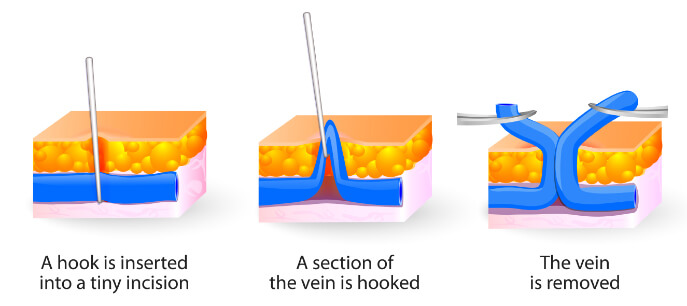 Microphlebectomy treatment illustration