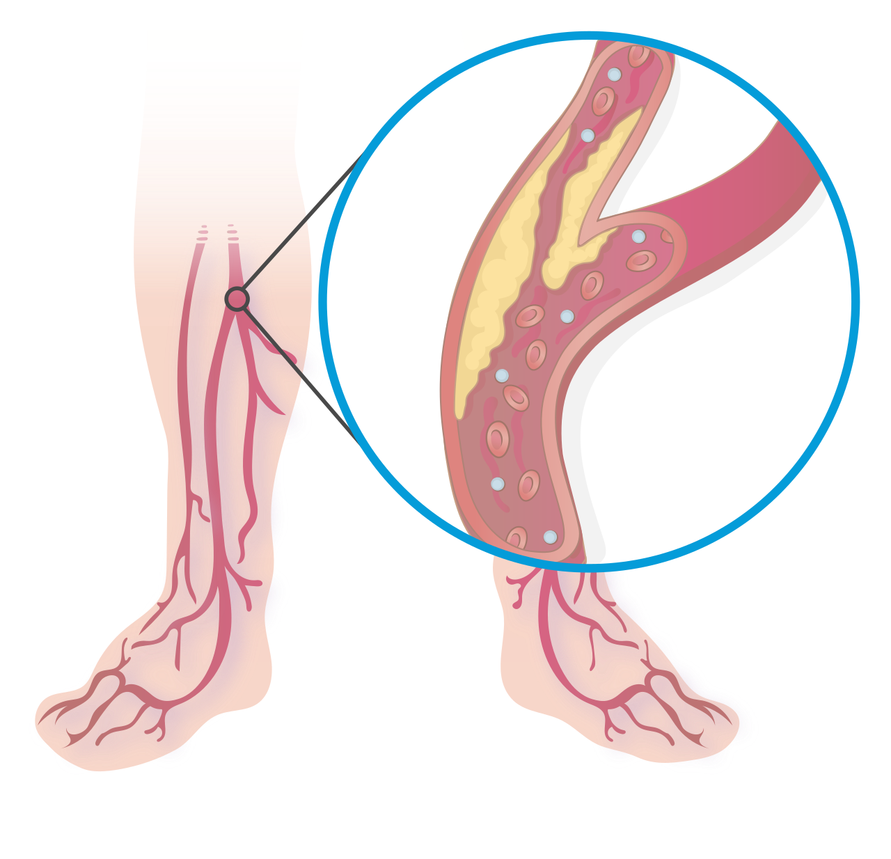 Illustration of peripheral artery disease affecting blood flow in the legs