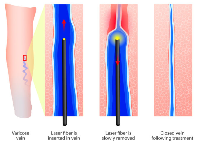 Radiofrequency ablation procedure
