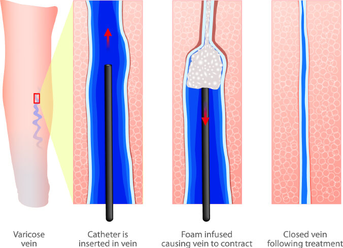 Sclerotherapy treatment