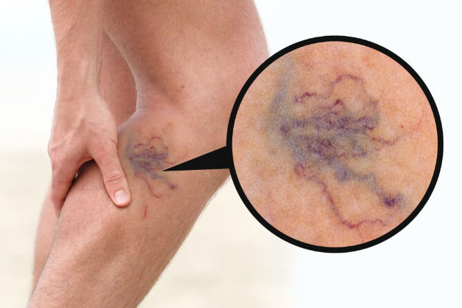 Spider veins on the leg