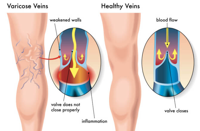 Varicose veins on the leg