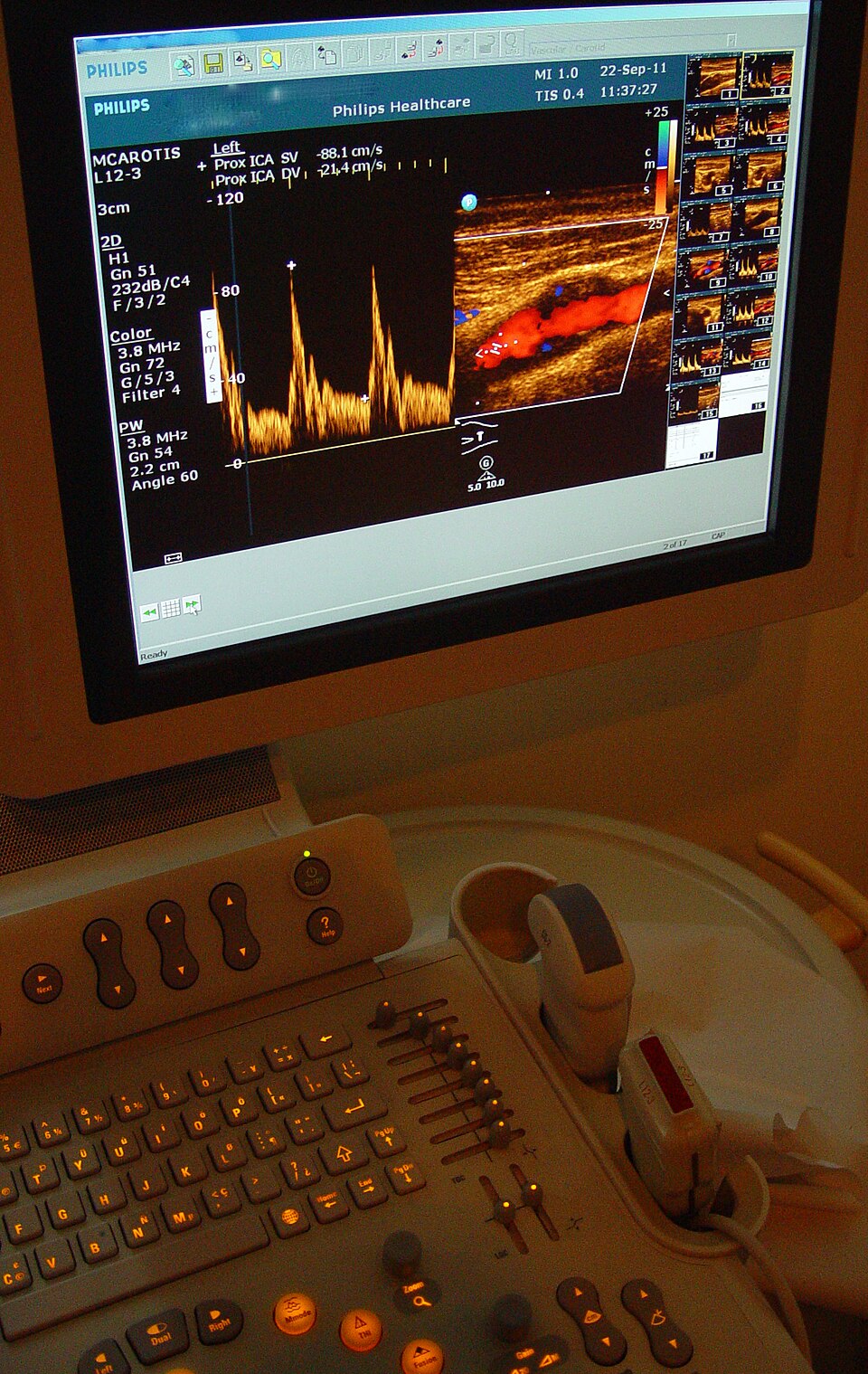 Carotid Doppler ultrasound image