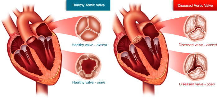 aortic-valve-stenosis