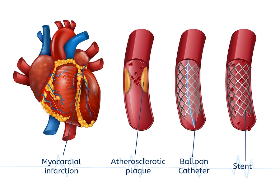 heart stent tampa cardio