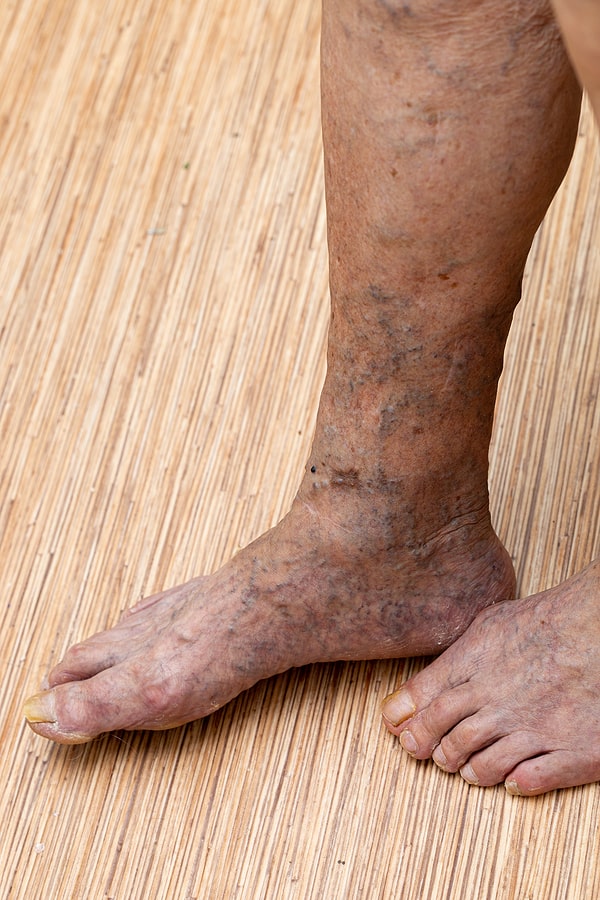 veins in feet tampa vein clinic