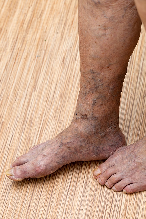 Wondering About The Bulging Veins In Your Feet We Have The Answers