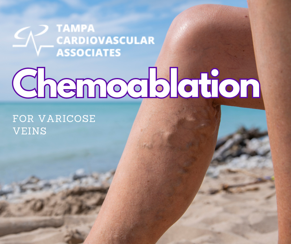 Chemoablation Tampa cardio vein clinic