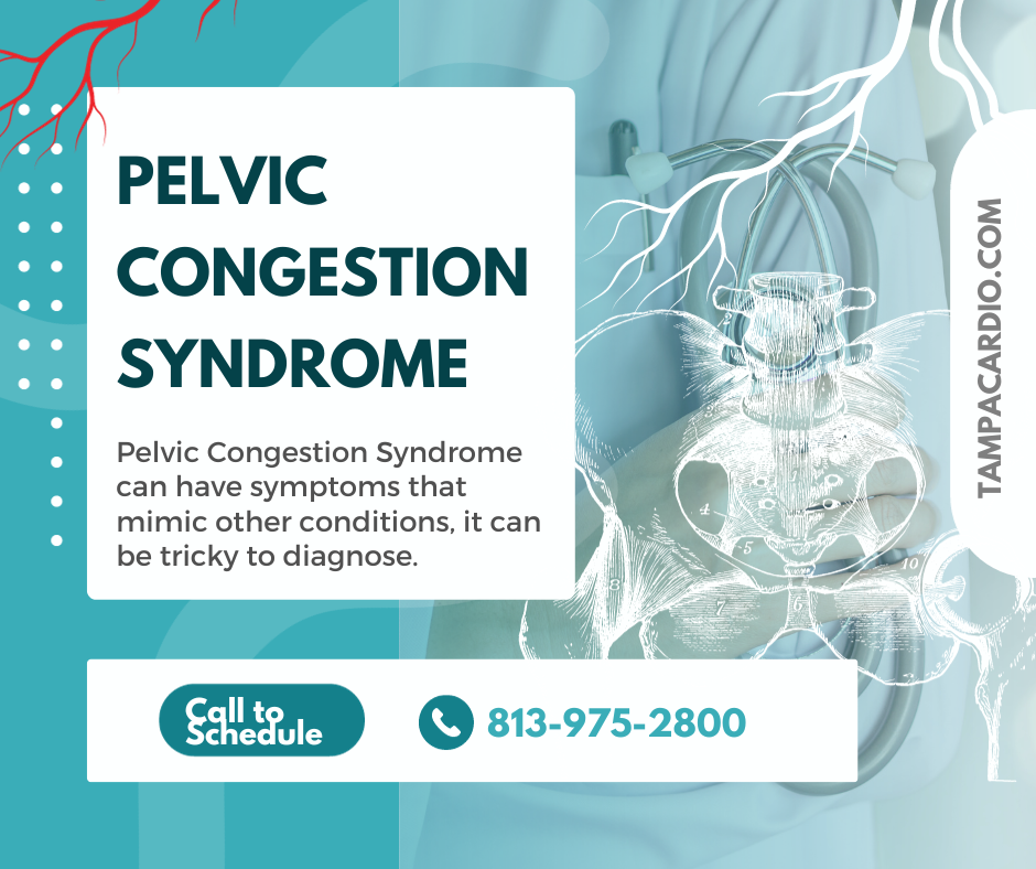 Pelvic COngestion Syndrome Tampa Cardio