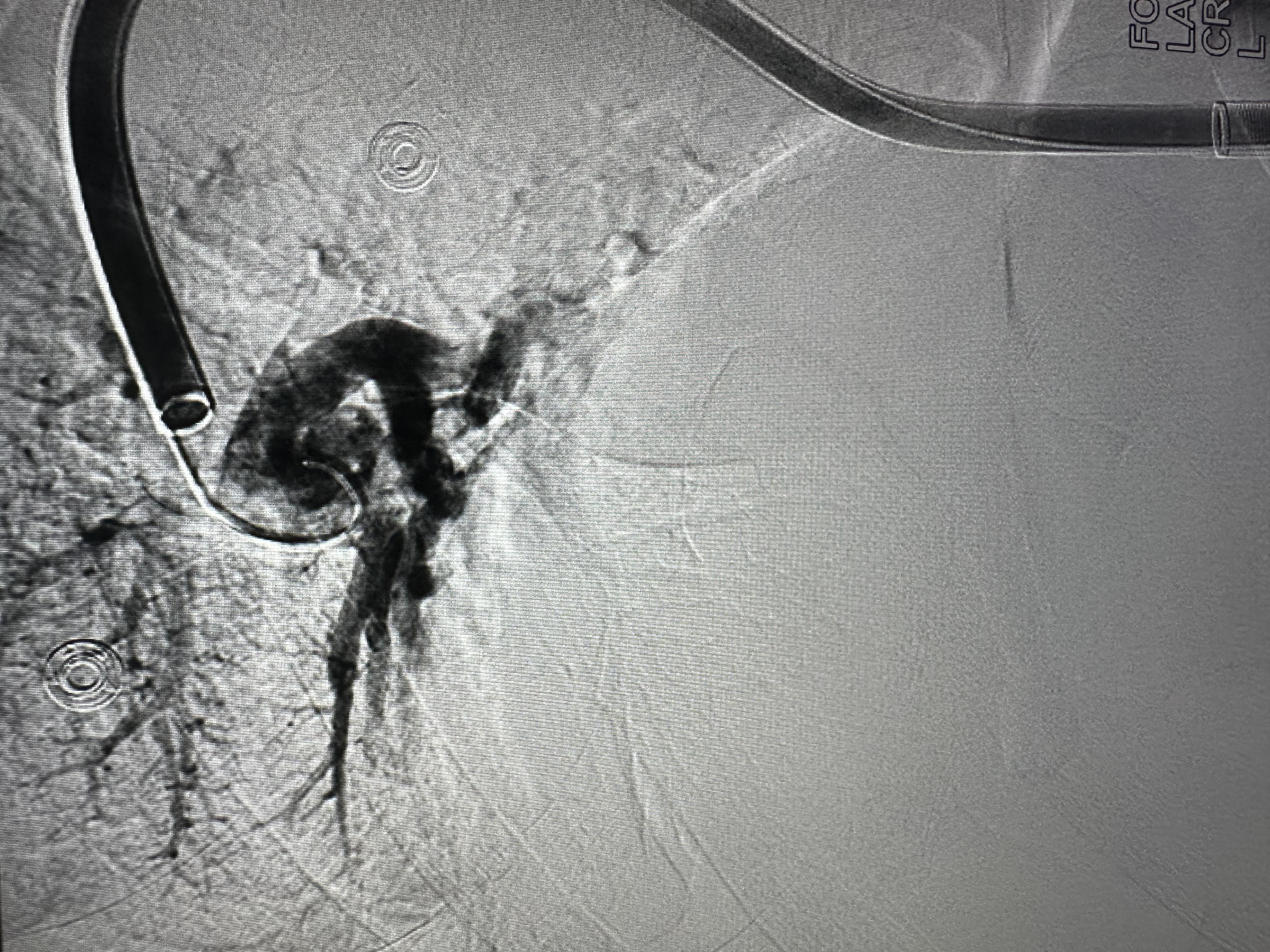 Treatment of massive pulmonary embolism with percutaneous mechanical thrombectomy
