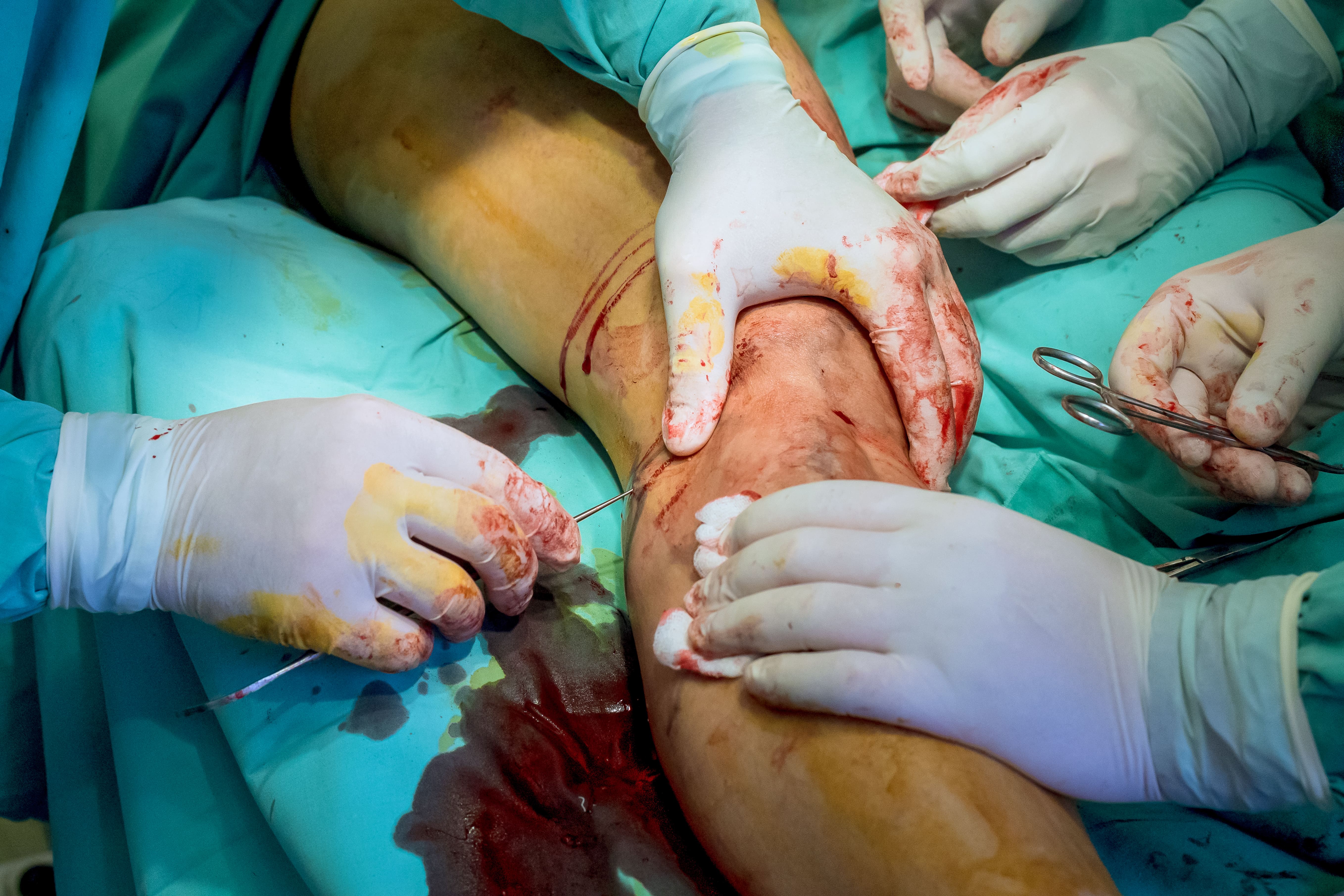Limb Salvage Procedures in Cardiovascular Surgery Tampa cardio