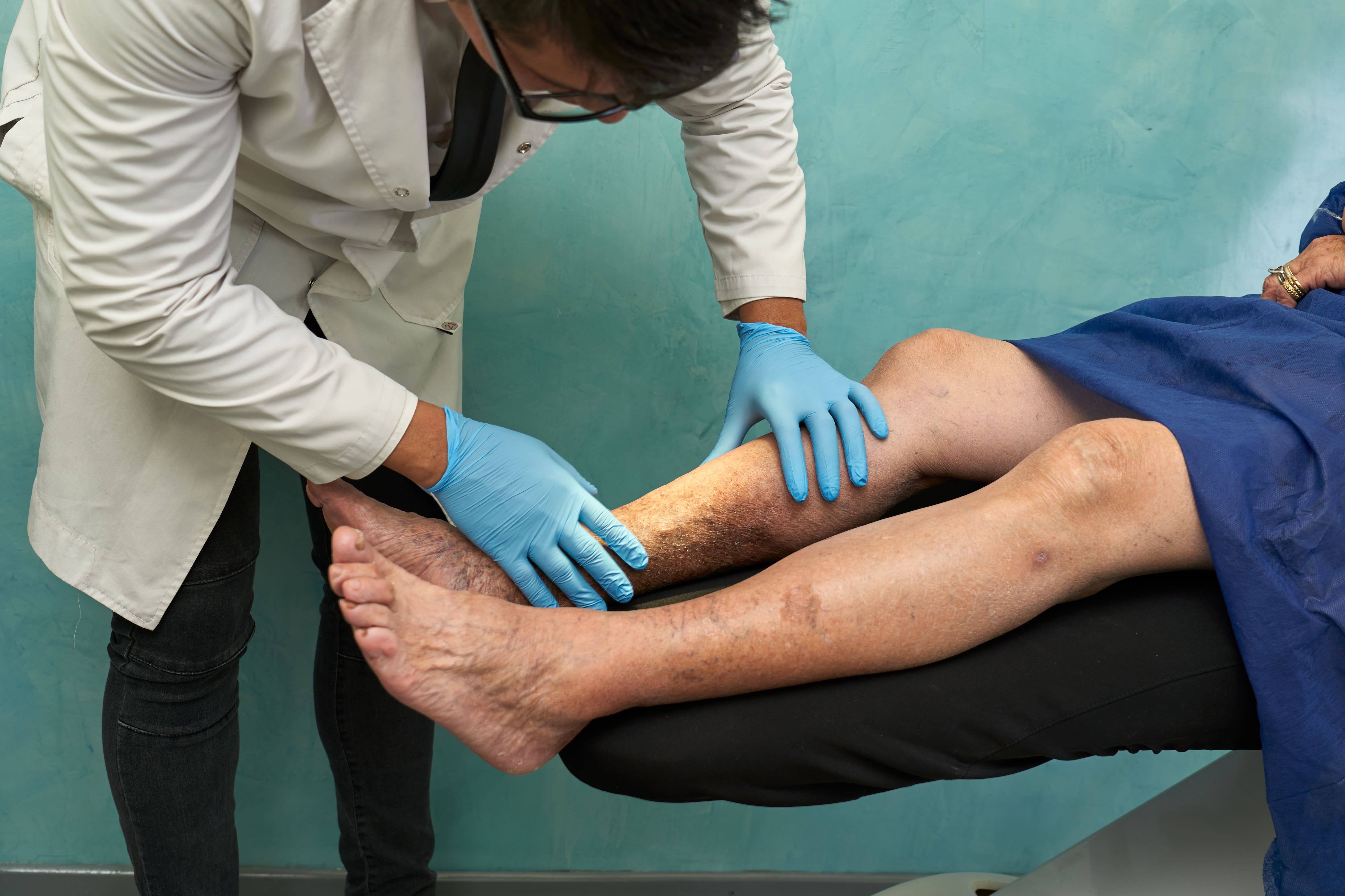 Treatment Options for Varicose Veins at Tampa Cardiovascular Associates